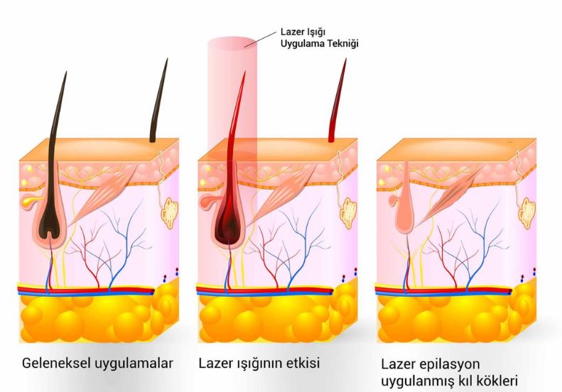 Genital Bölge Buz Lazer Acıyor mu