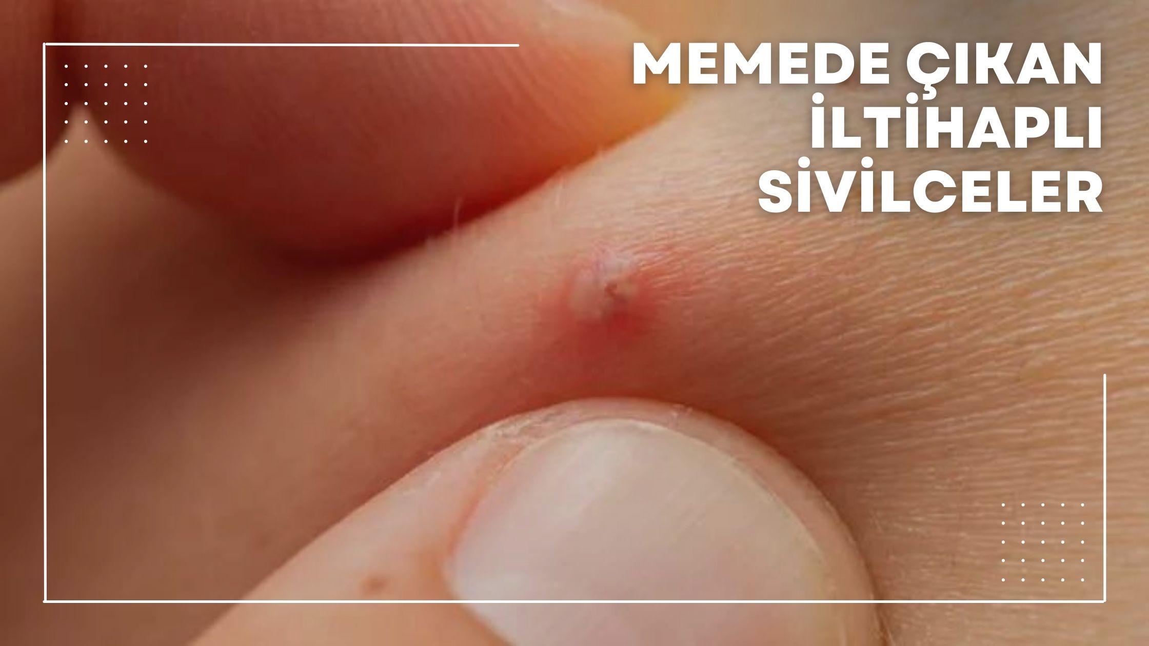 Memede Çıkan İltihaplı Sivilceler