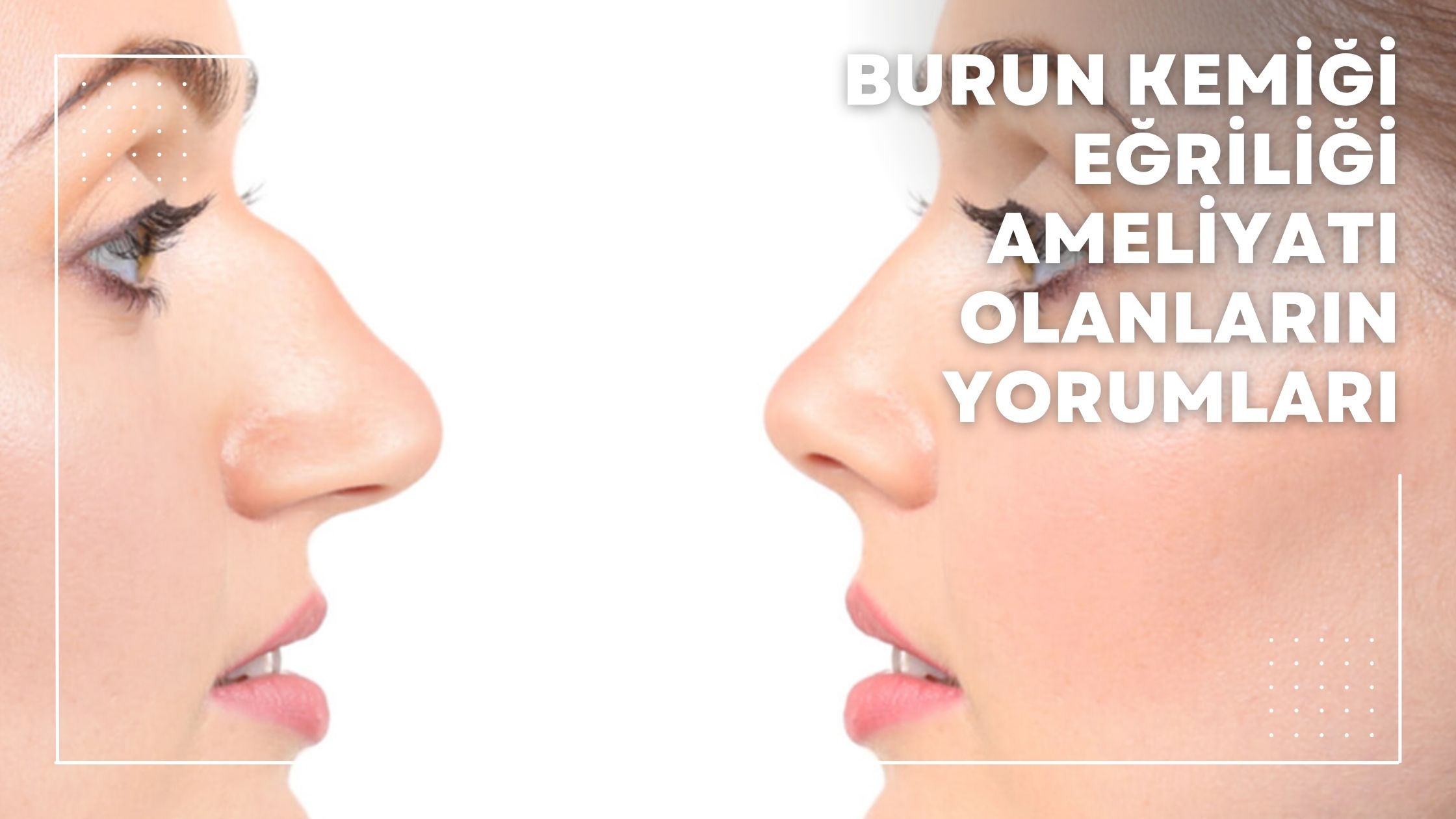 Burun Kemiği Eğriliği Ameliyatı Olanların Yorumları