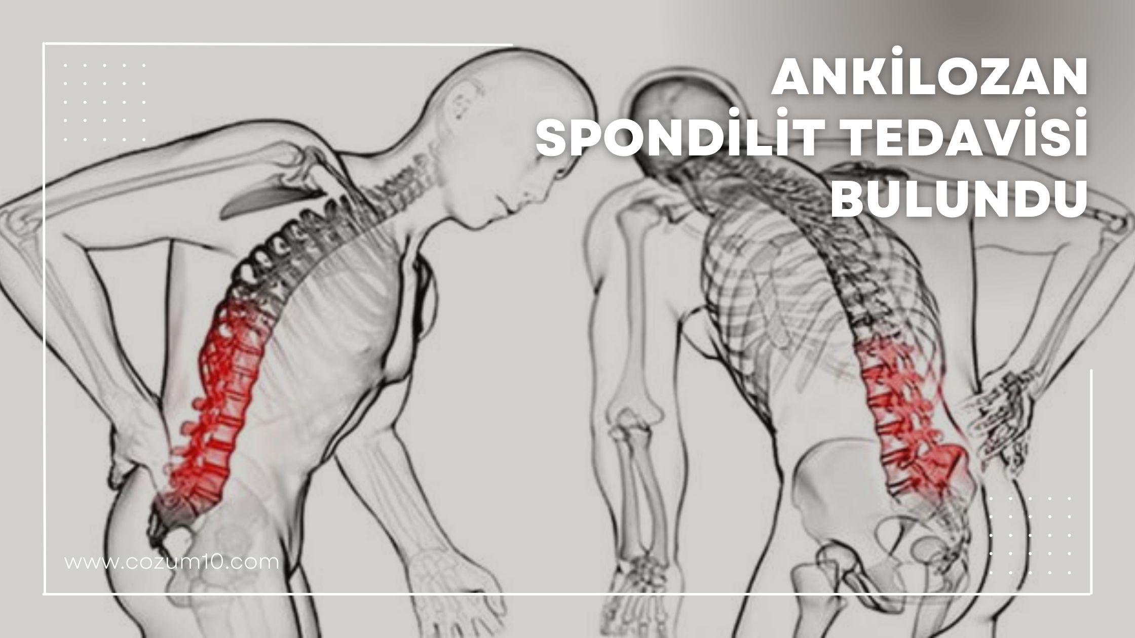 Ankilozan Spondilit Tedavisi Bulundu