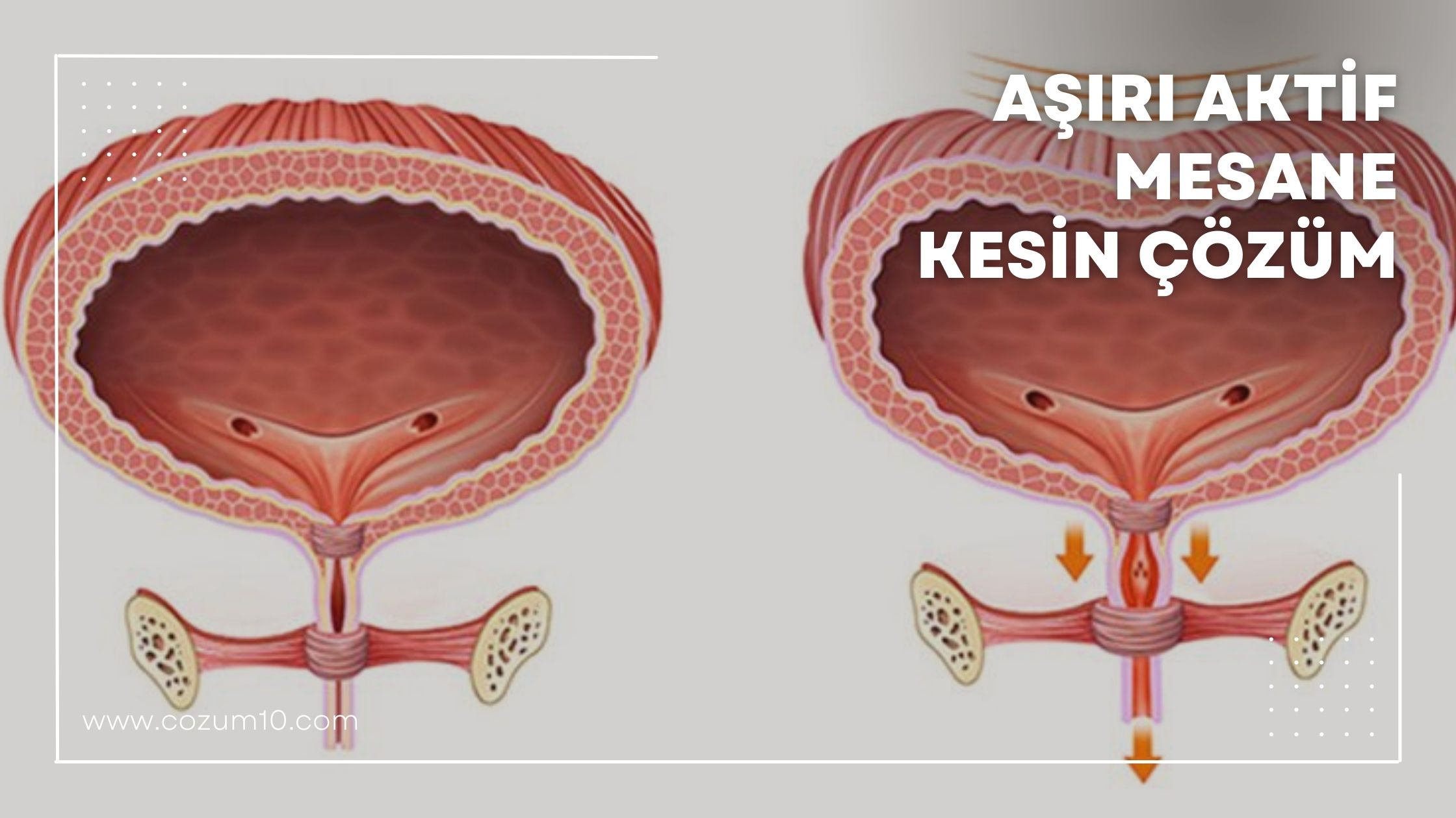 Aşırı Aktif Mesane Kesin Çözüm