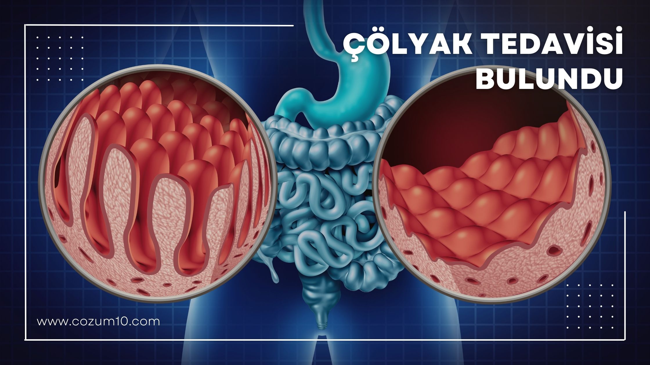 Çölyak Tedavisi Bulundu