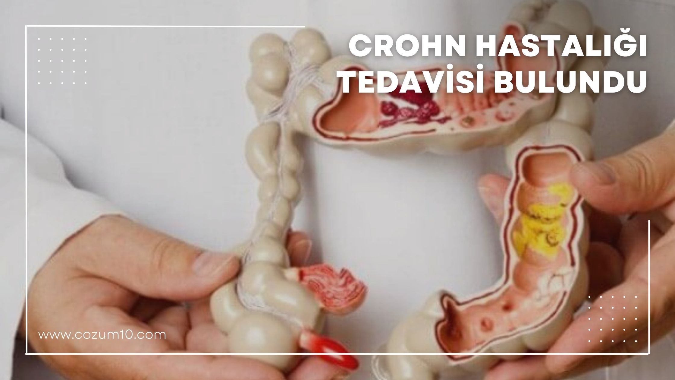 Crohn Hastalığı Tedavisi Bulundu