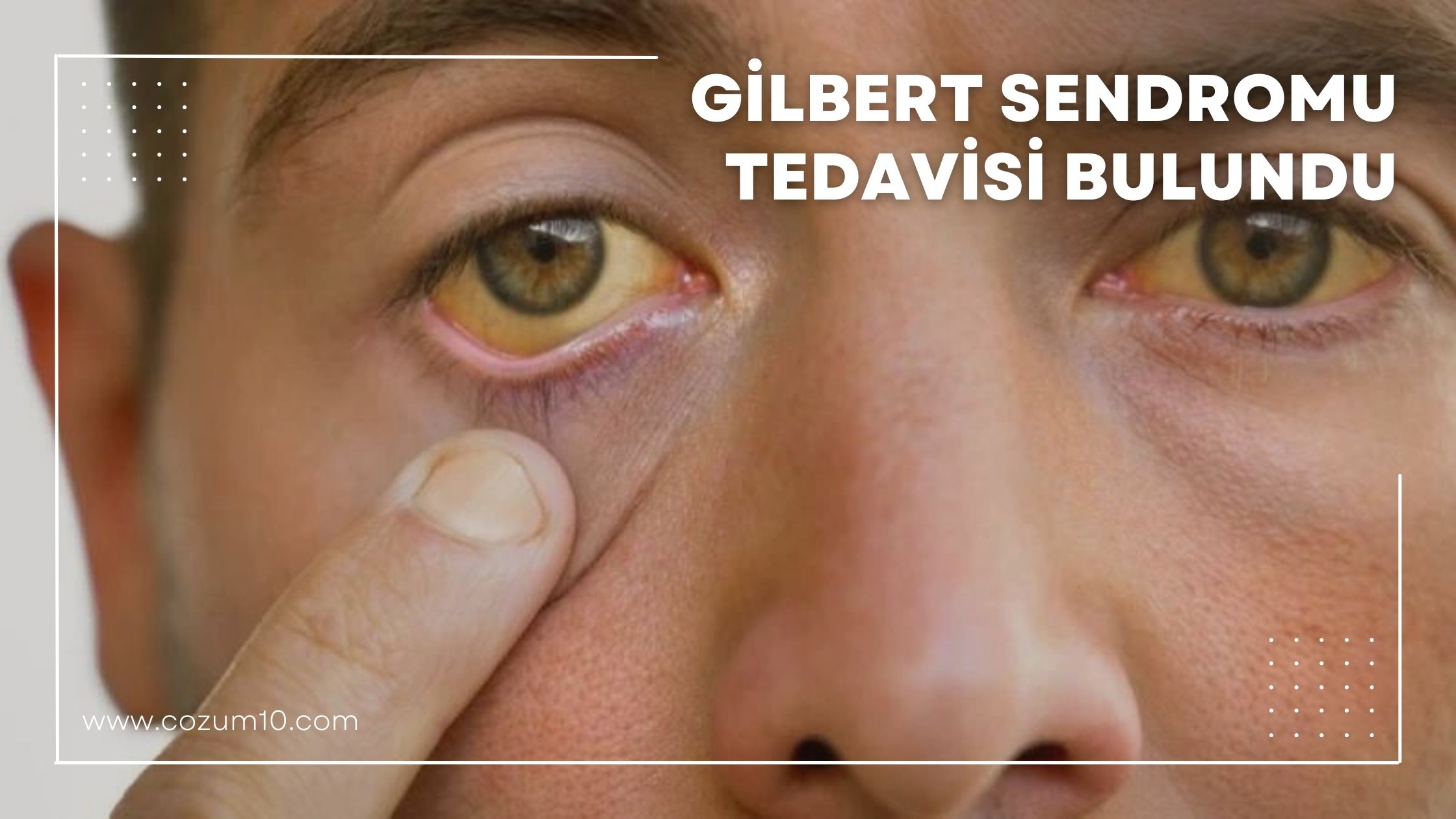 Gilbert Sendromu Tedavisi Bulundu
