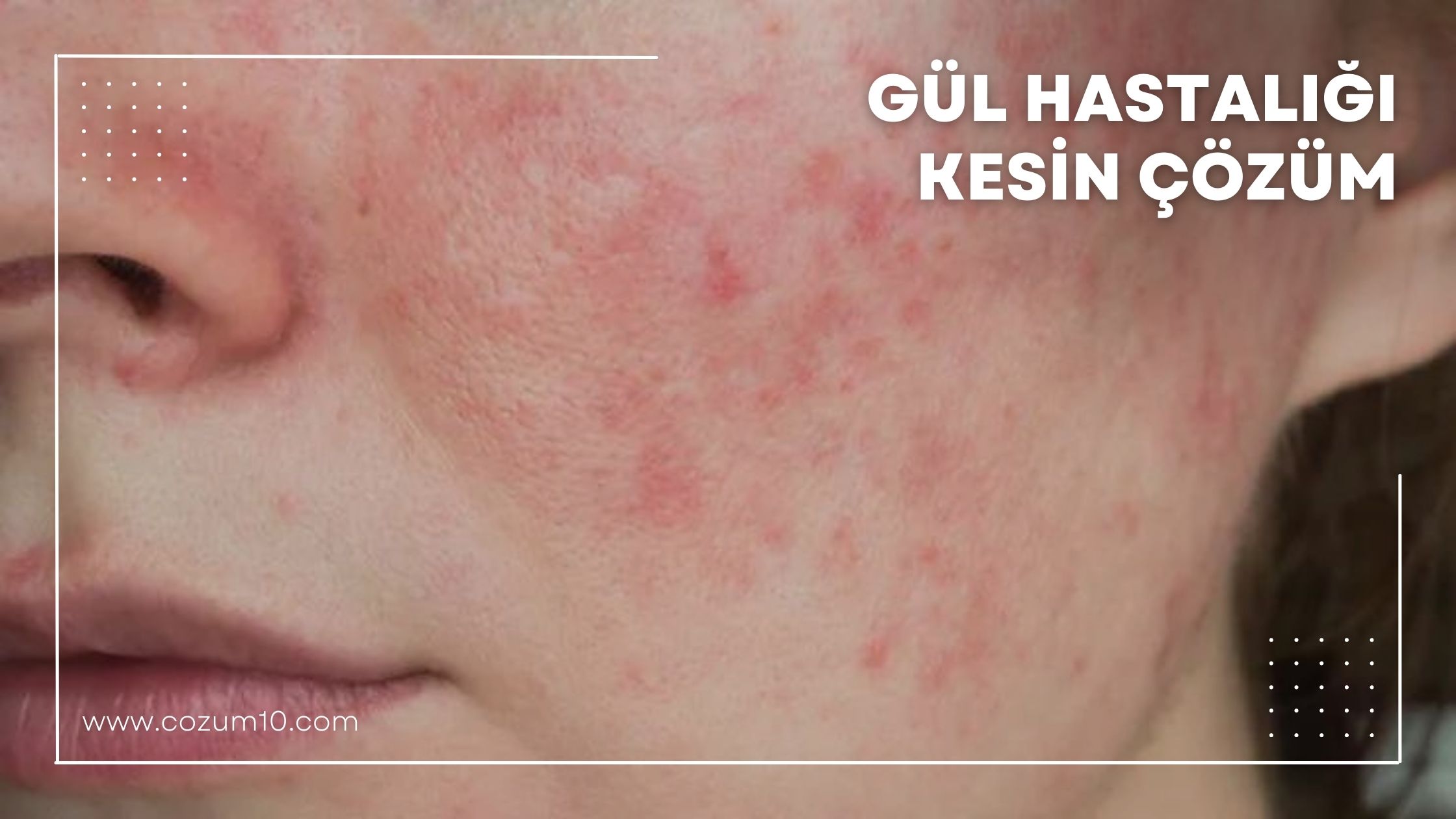 Gül Hastalığı Kesin Çözüm