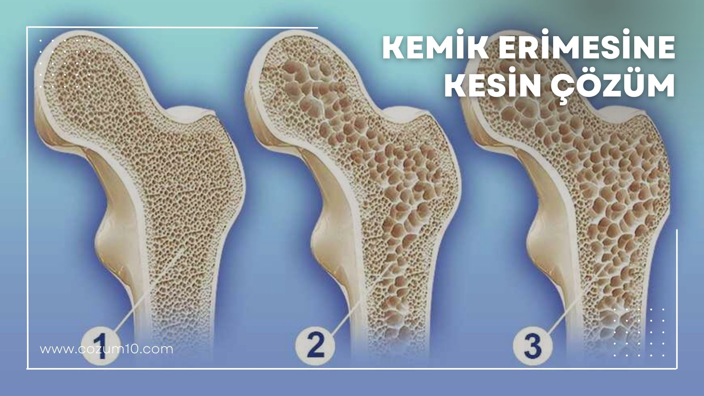 Kemik Erimesine Kesin Çözüm