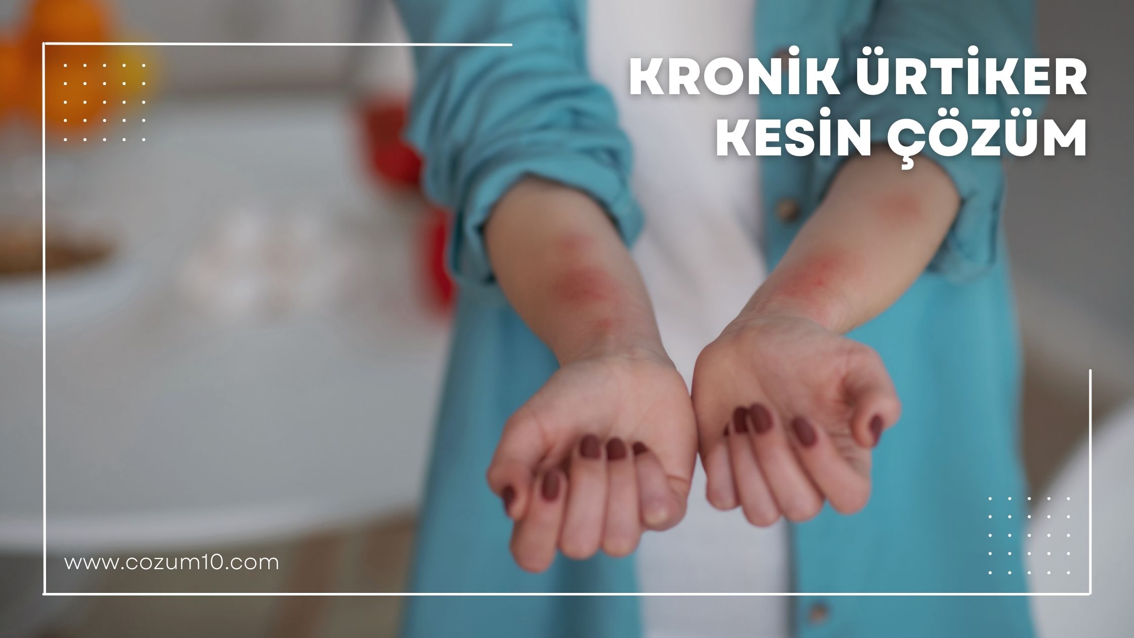 Kronik Ürtiker Kesin Çözüm