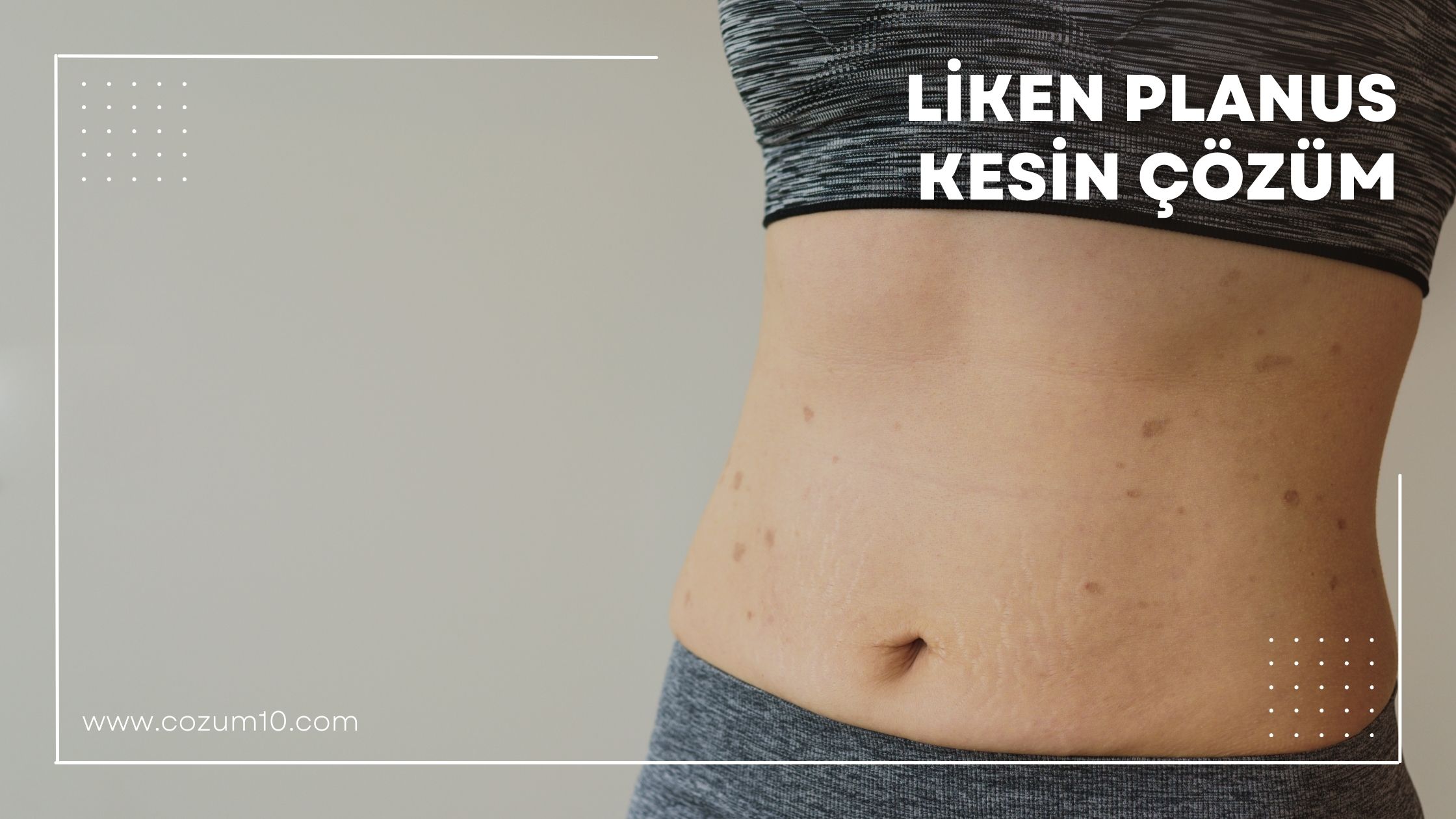 Liken Planus Kesin Çözüm