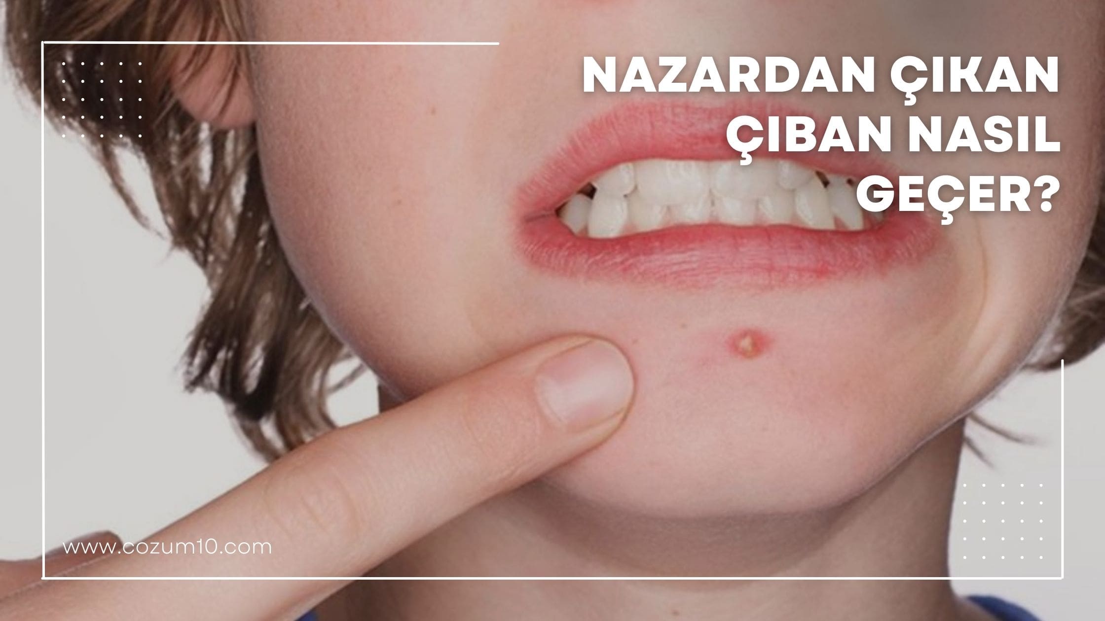 Nazardan Çıkan Çıban Nasıl Geçer?
