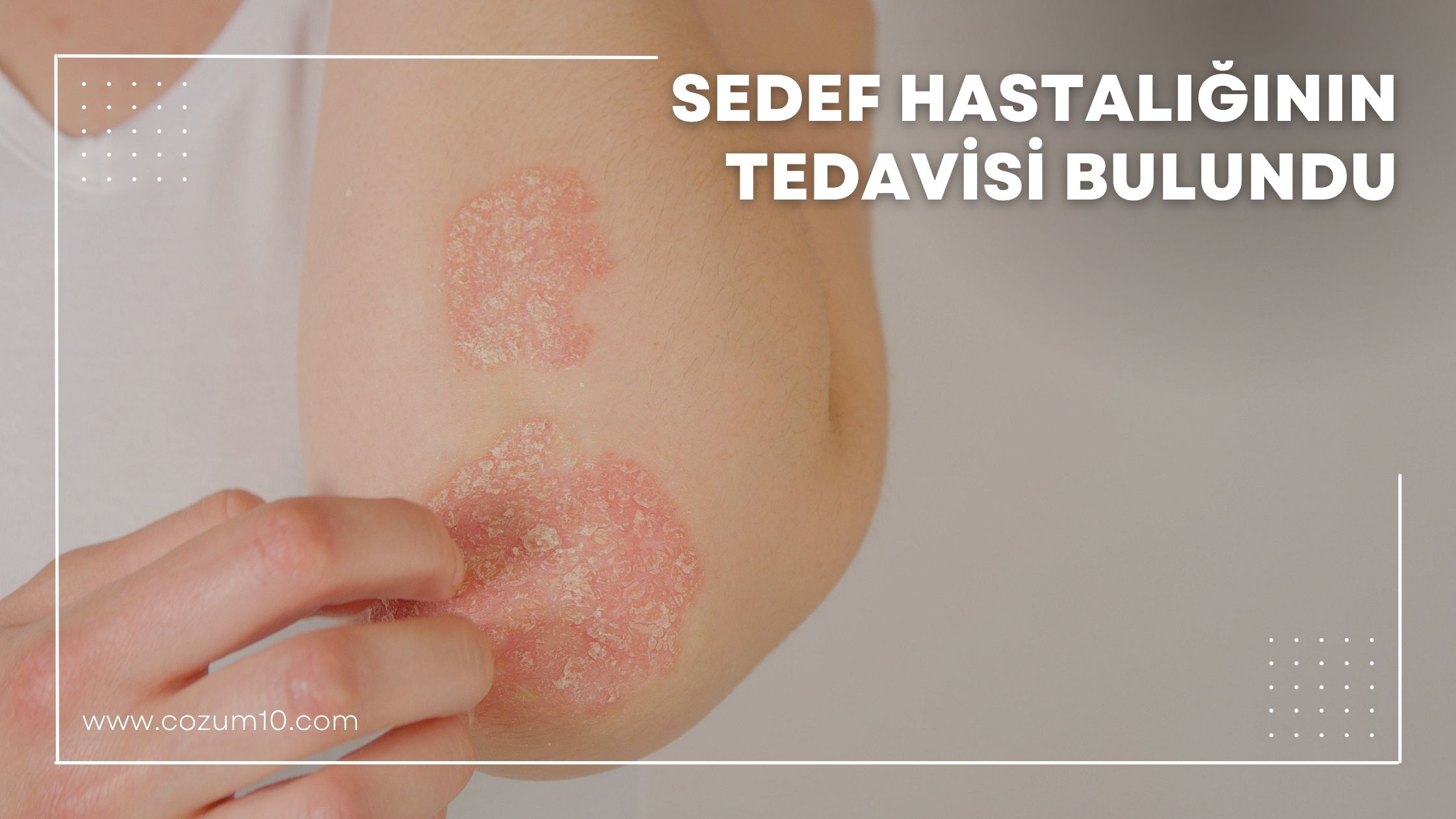 Sedef Hastalığının Tedavisi Bulundu