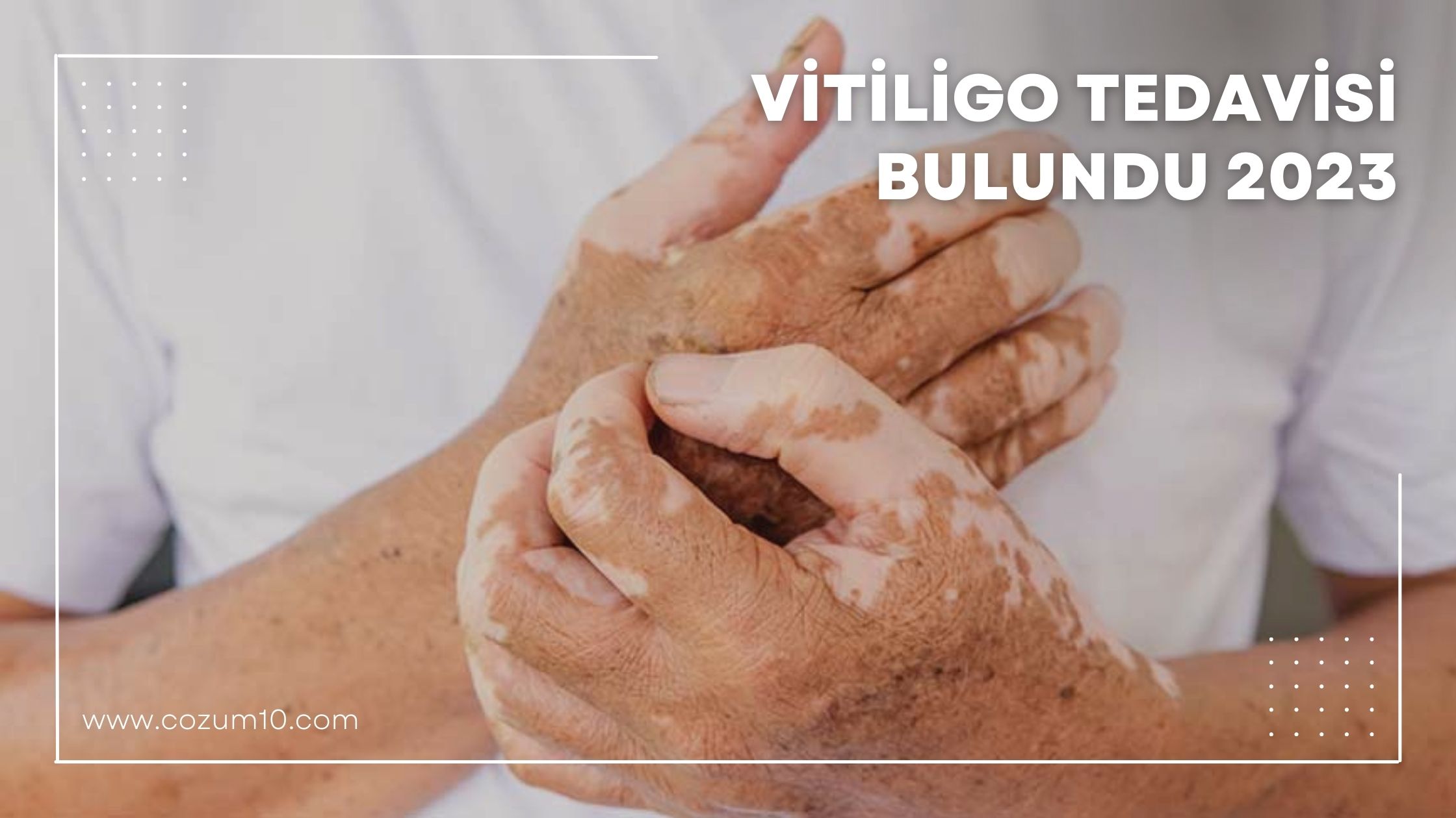 Vitiligo Tedavisi Bulundu 2023