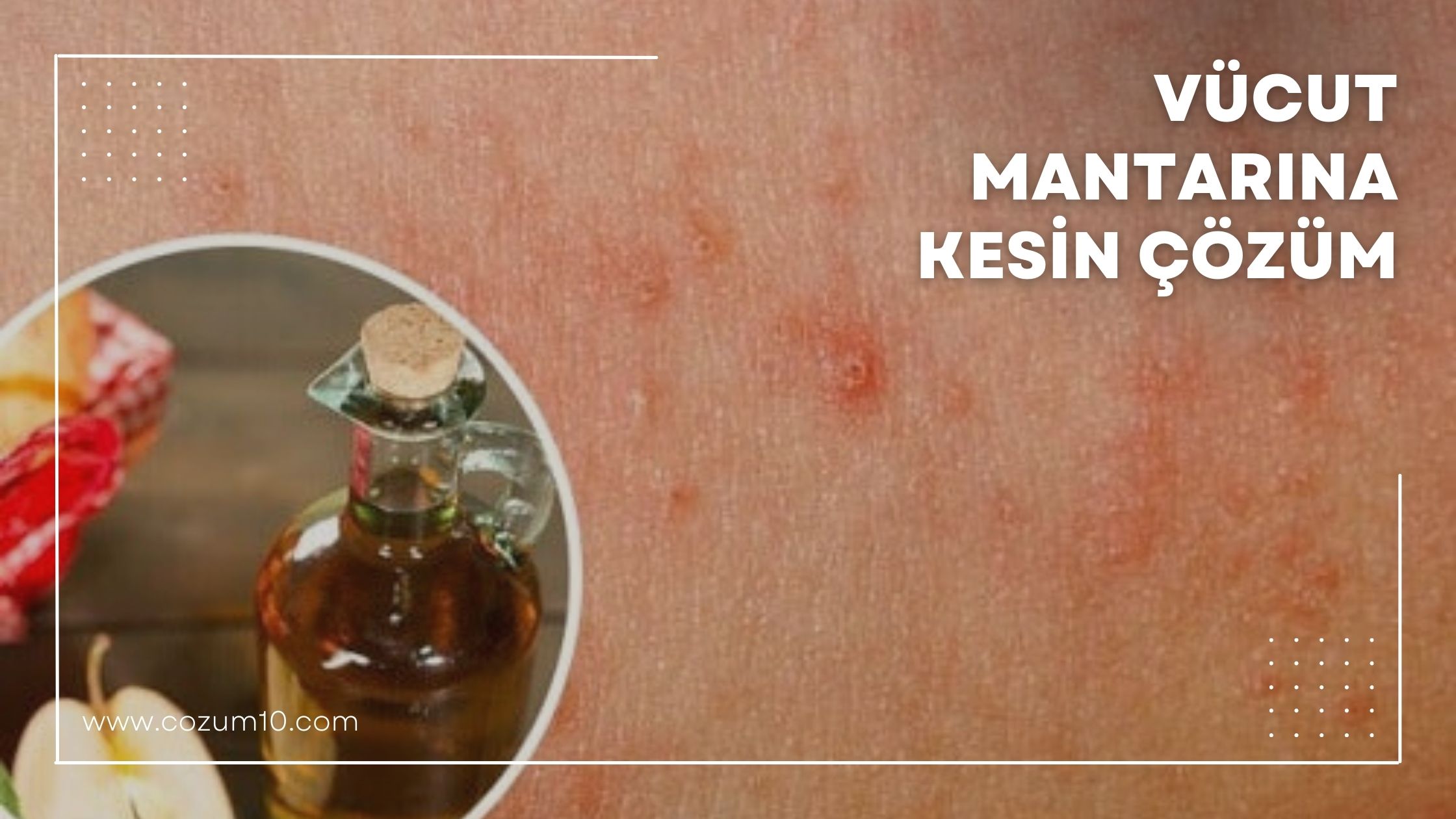 Vücut Mantarına Kesin Çözüm