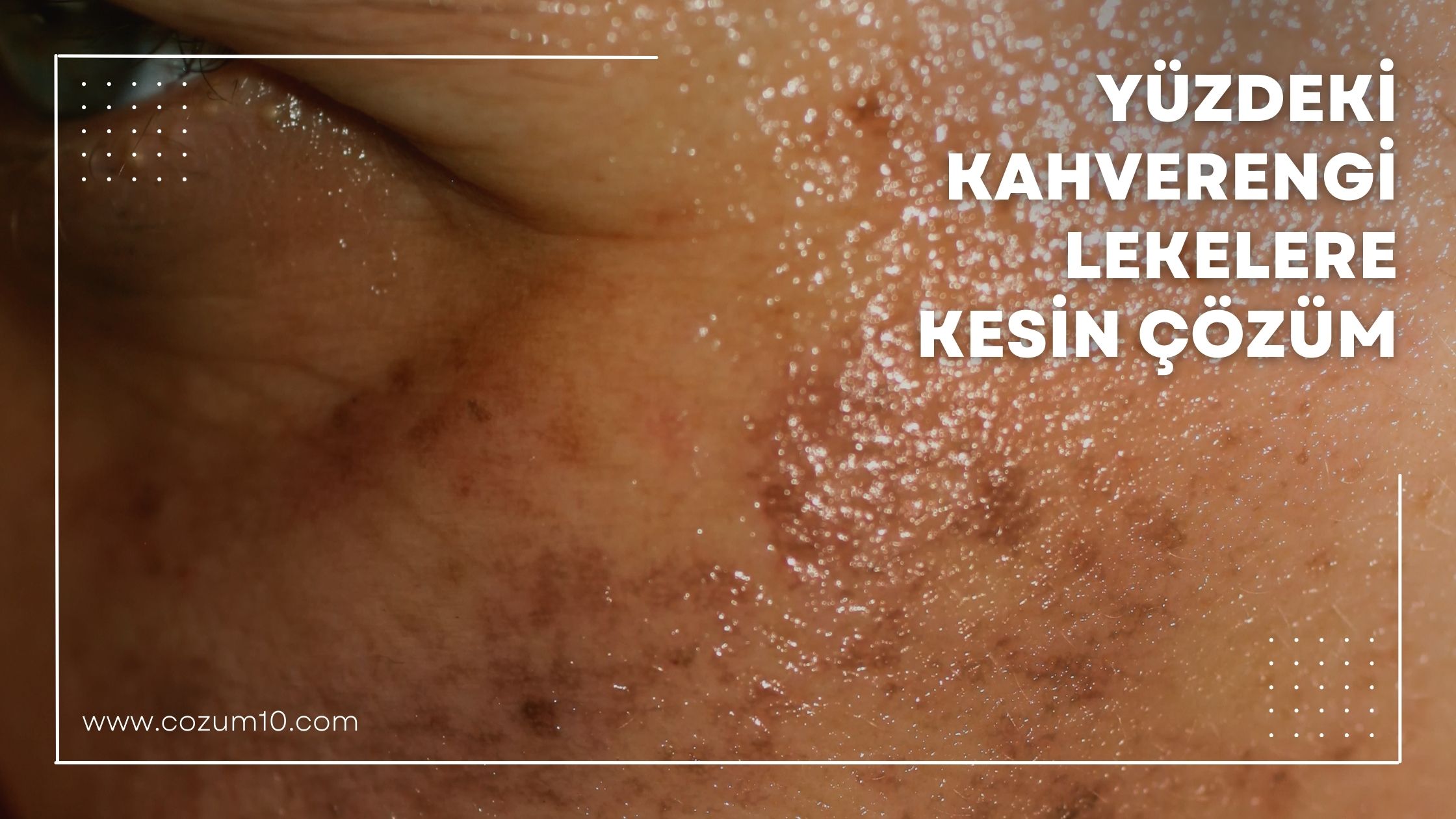 Yüzdeki Kahverengi Lekelere Kesin Çözüm
